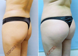 Buttock Implants