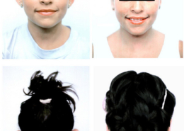 Ear Contouring Surgery
