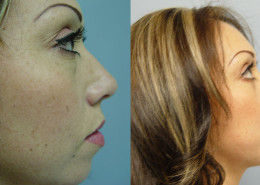 Eyelid Surgery