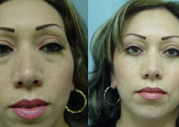 Eyelid Surgery