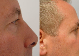 Eyelid Surgery