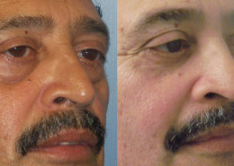 Eyelid Surgery