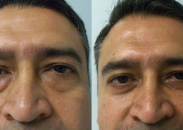 Eyelid Surgery
