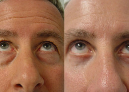Eyelid Surgery