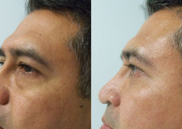 Eyelid Surgery