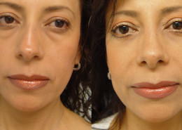 Eyelid and Nose Surgery