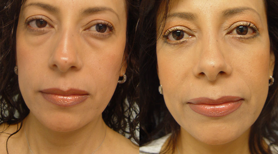 Eyelid and Nose Surgery