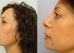 Eyelid and Nose Surgery