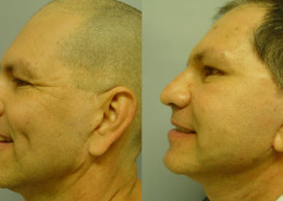 Vertical Facelift