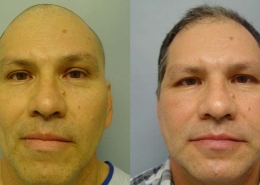 Vertical Facelift
