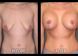 Breast Lift With Augmentation