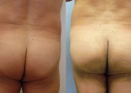 Buttock Augmentation