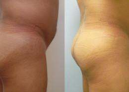 Buttock Augmentation