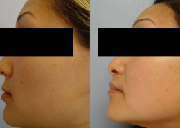Hollywood Smile Procedure