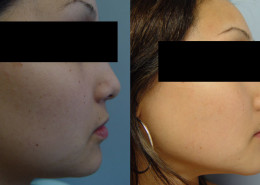 Hollywood Smile Procedure