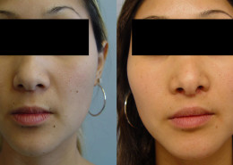 Hollywood Smile Procedure