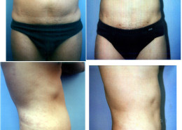 Liposuction