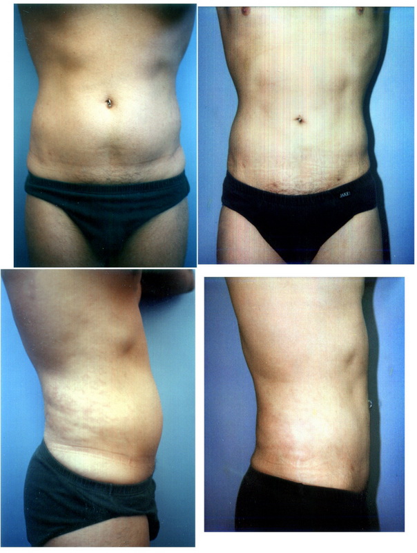 Liposuction