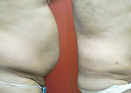 Liposuction
