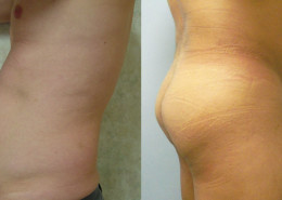Liposuction