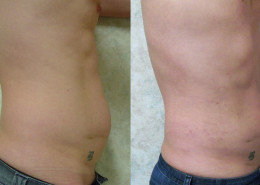 Liposuction