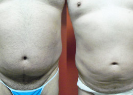 Liposuction