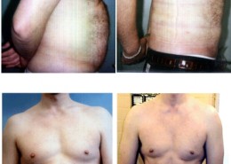 Liposuction