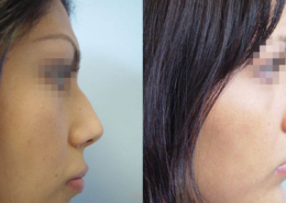 Nose Sculpting Surgery