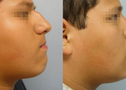 Nose Sculpting Surgery