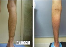 Calf Implants