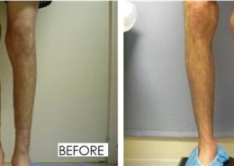 Calf Implants