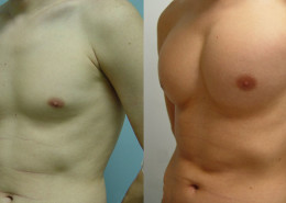 Pectoral Implants