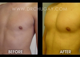 Pectoral Implants
