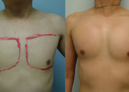 Pectoral Implants