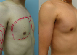 Pectoral Implants