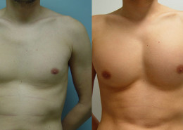 Pectoral Implants