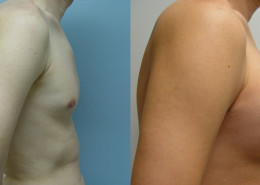 Pectoral Implants