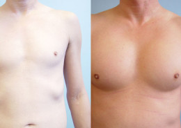Pectoral Implants