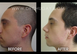 Nose Sculpting Surgery