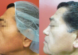 Nose Sculpting Surgery