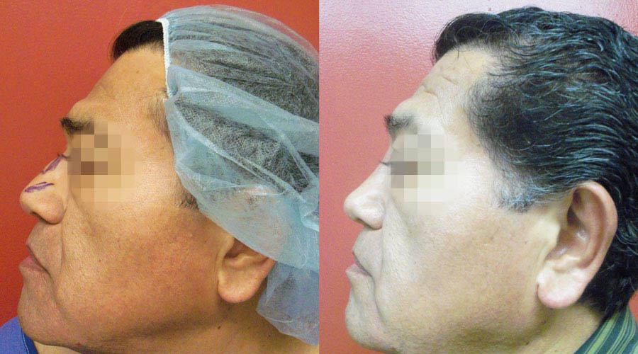 Nose Sculpting Surgery