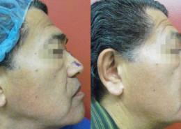 Nose Sculpting Surgery