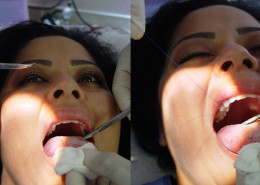 Tongue Patch Surgery | Weight Loss