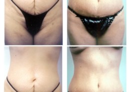 Tummy Tuck