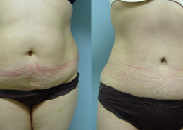 Tummy Tuck