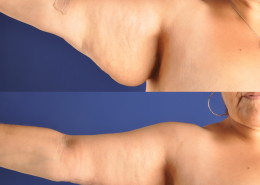 Arm Lift Surgery