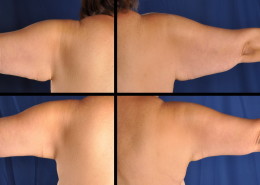 Arm Lift Surgery