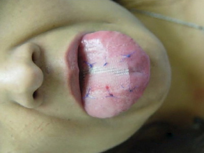 The Tongue patch weight loss procedure, pioneered by Dr. Nikolas Chugay of Chugay Cosmetic Surgical Clinic