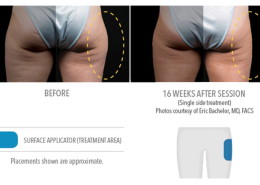 Coolsculpting Non-Surgical Fat Removal