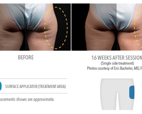 Coolsculpting Non-Surgical Fat Removal